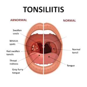 What Strep Throat Looks Like & Common Symptoms | NextCare