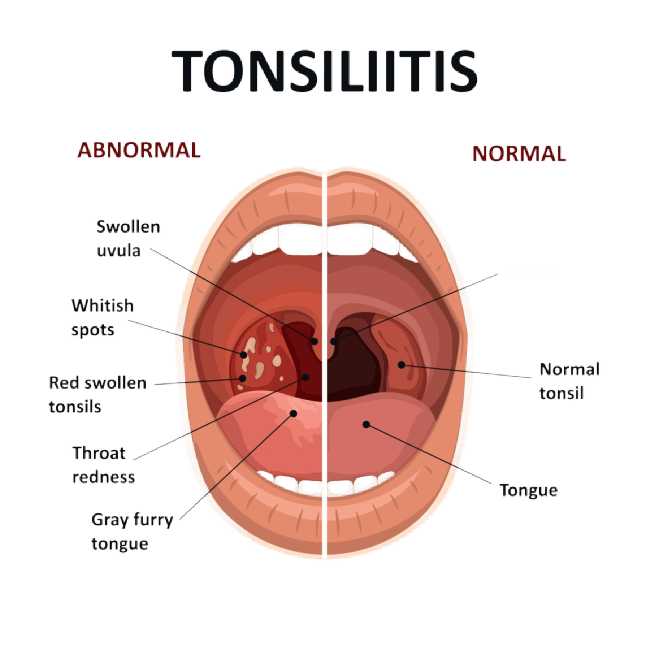 Tonsillitis vs. Strep Throat: Spot the Difference