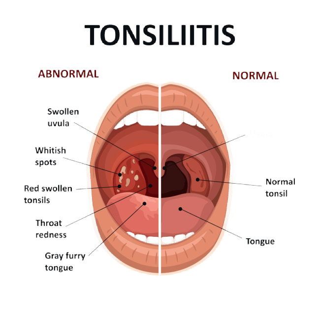 normal tonsils vs infected tonsils