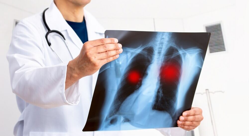 doctor looking at chest x-ray