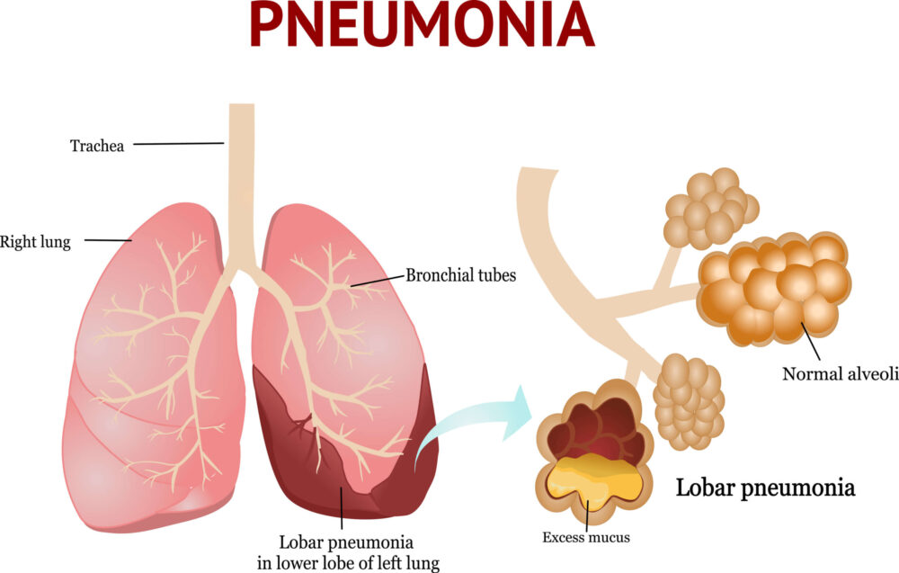 illustration of a lung with Pneumonia