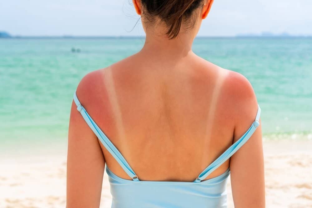 Women on the beach sunburned on shoulders