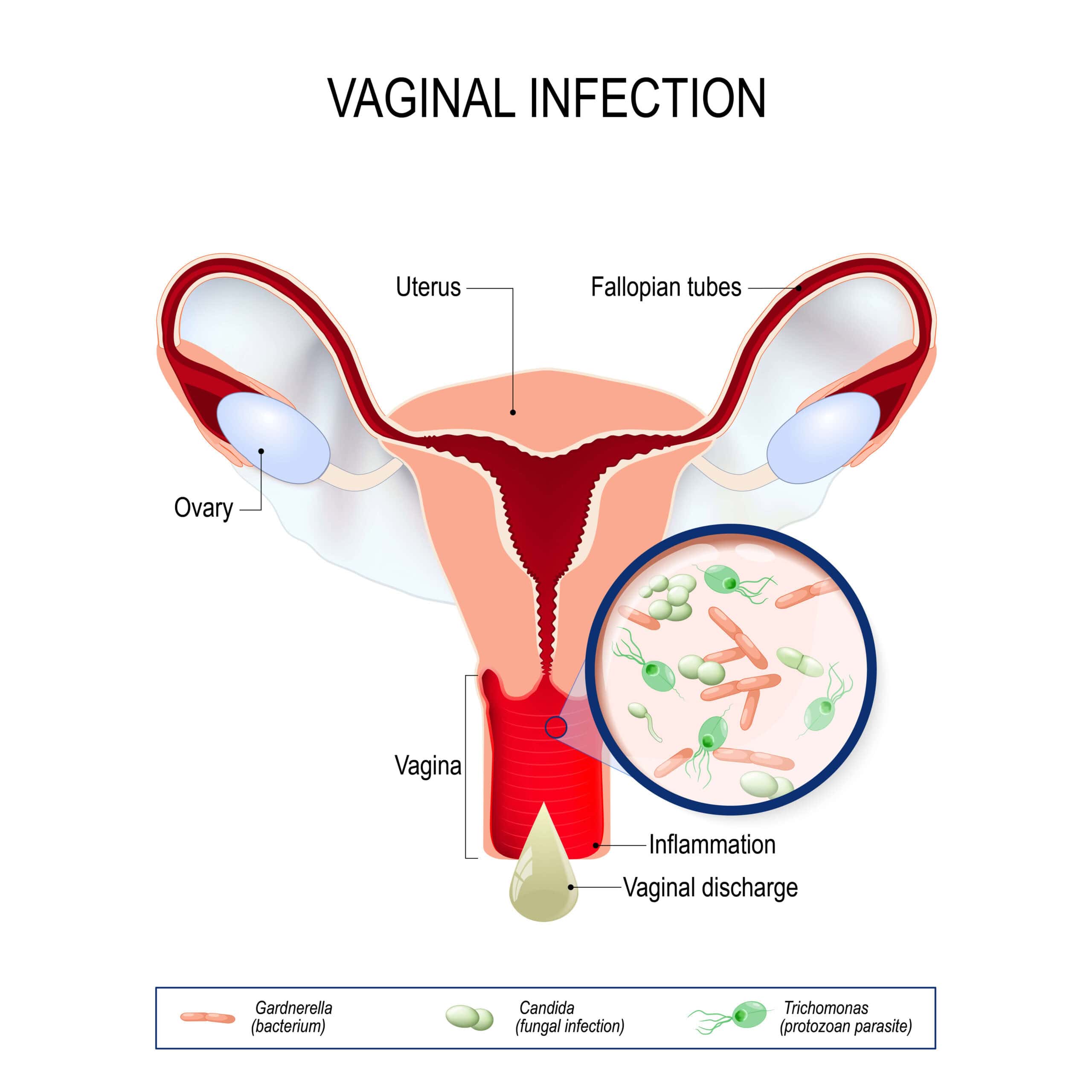 Illustration of a uterus with a yeast infection - NextCare