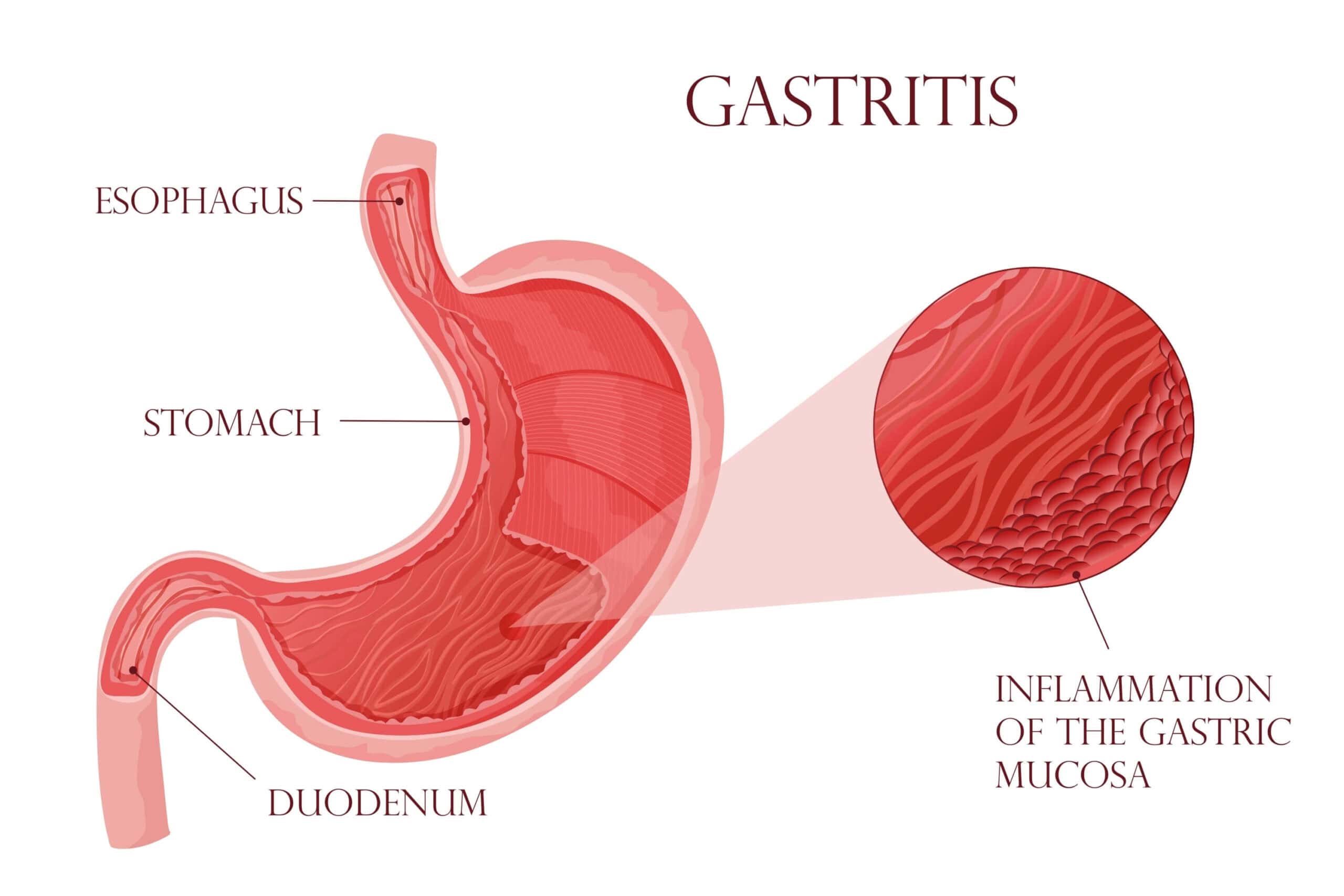 illustration of a stomach with gastritis inflammation