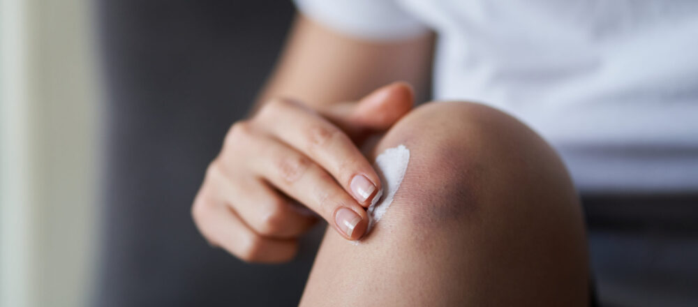 A woman applying crème to heal a bruise