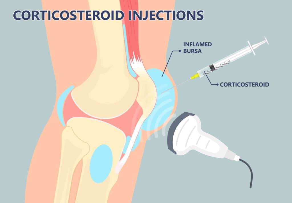 Illustration of corticosteroid injection targeting an inflamed trochanteric bursa, highlighting hip pain treatment - NextCare Urgent Care