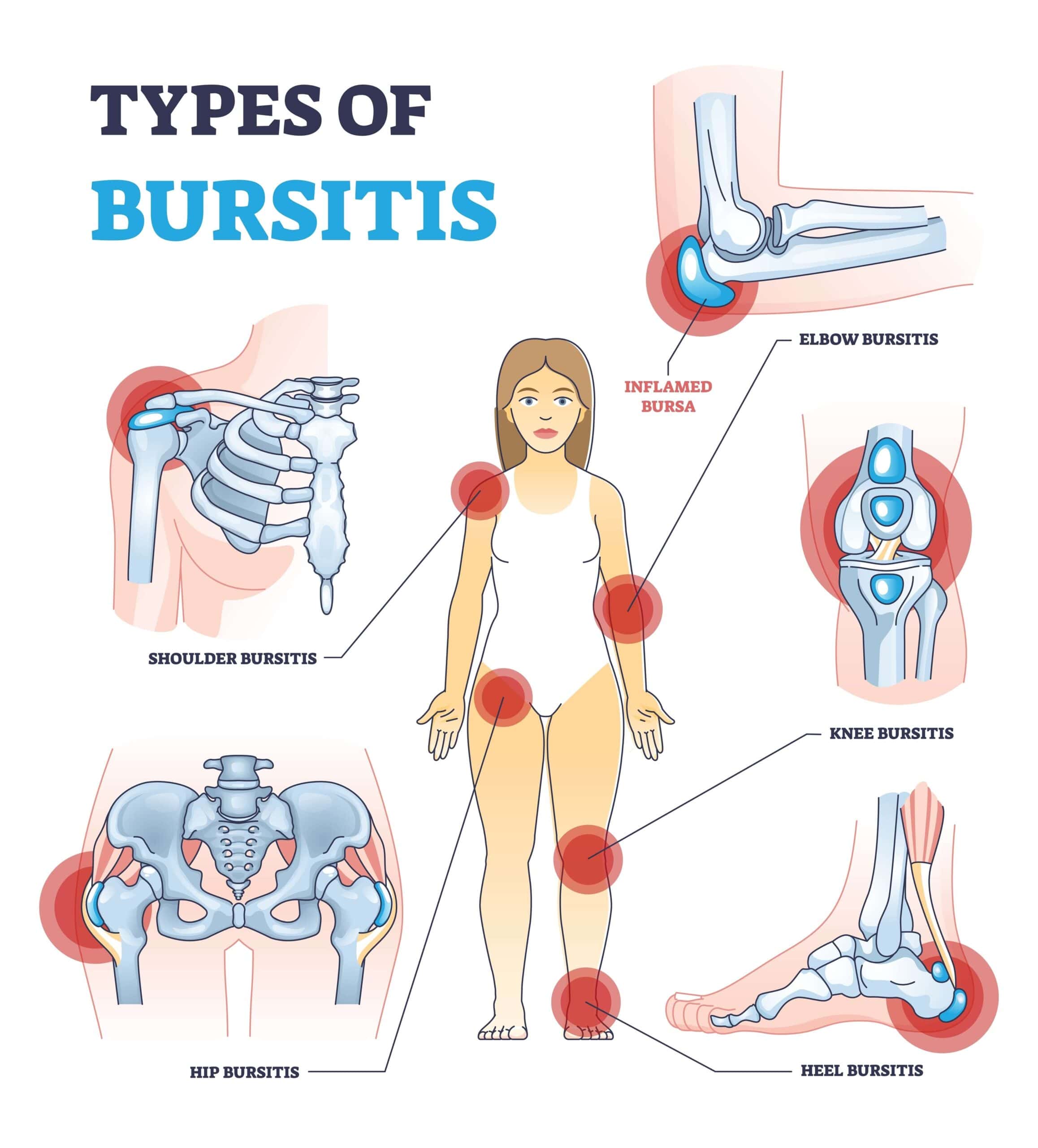 Diagram of common bursitis types: shoulder, elbow, hip, knee, and heel, showing affected joints and symptoms in the human body - NextCare Urgent Care