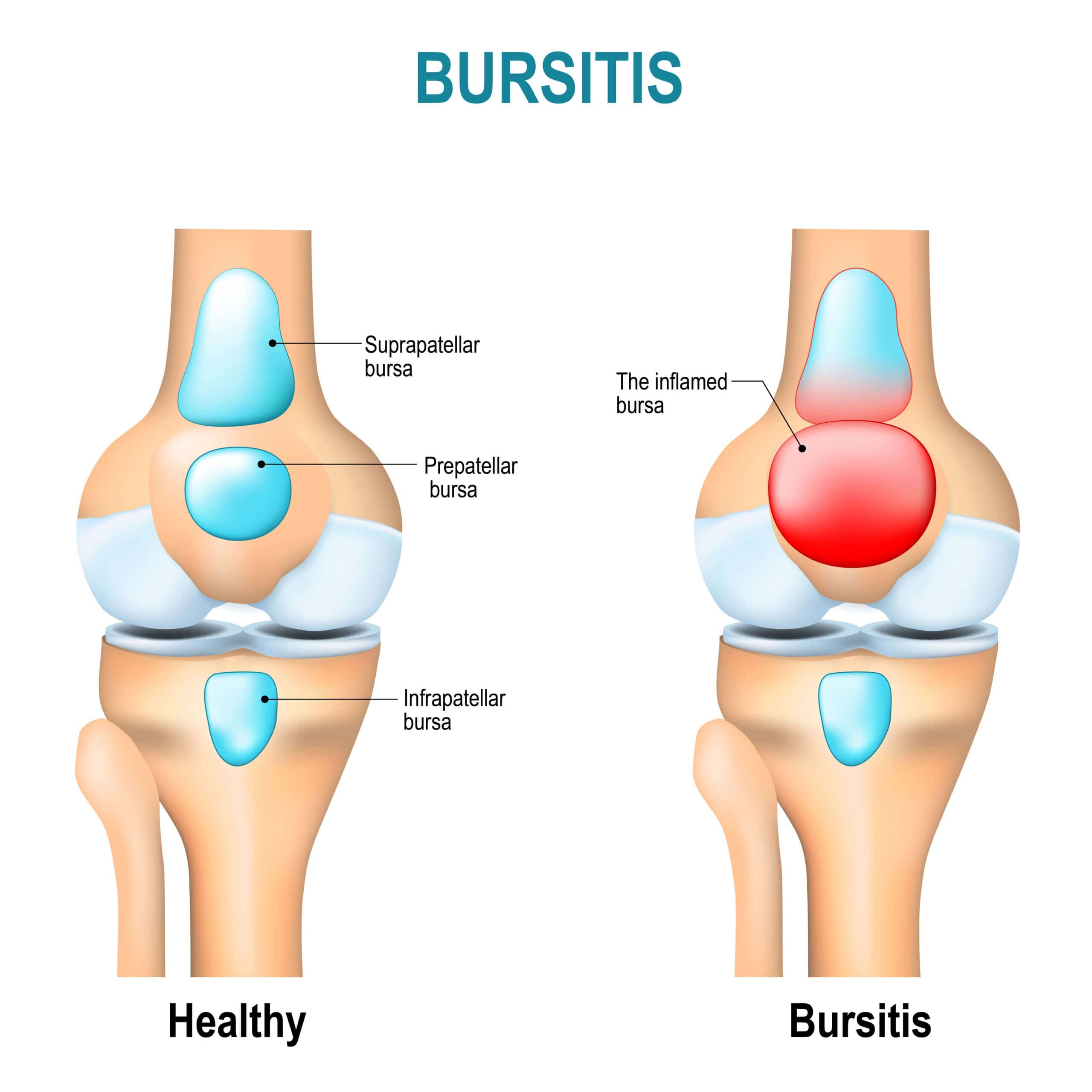 Illustration comparing a healthy knee with bursitis, highlighting the suprapatellar, prepatellar, and infrapatellar bursae, with inflammation marked in red. NextCare Urgent Care.