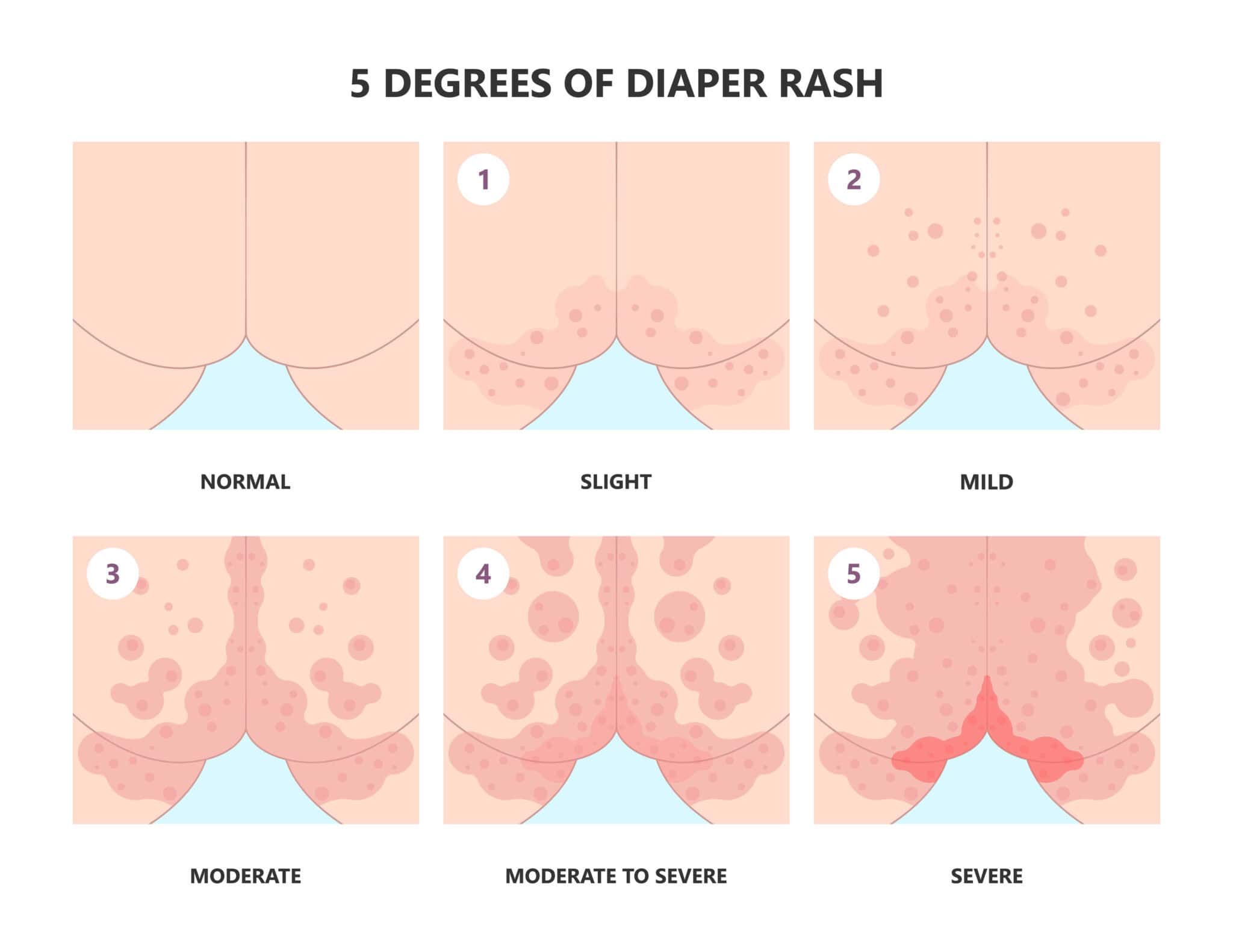 Urgent Care for Diaper Rash Treatment | walk-in clinic diaper rash ...