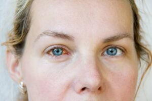 Close-up photo of a woman's eye showing signs of keratitis, including redness, inflammation, and cloudiness in the cornea.