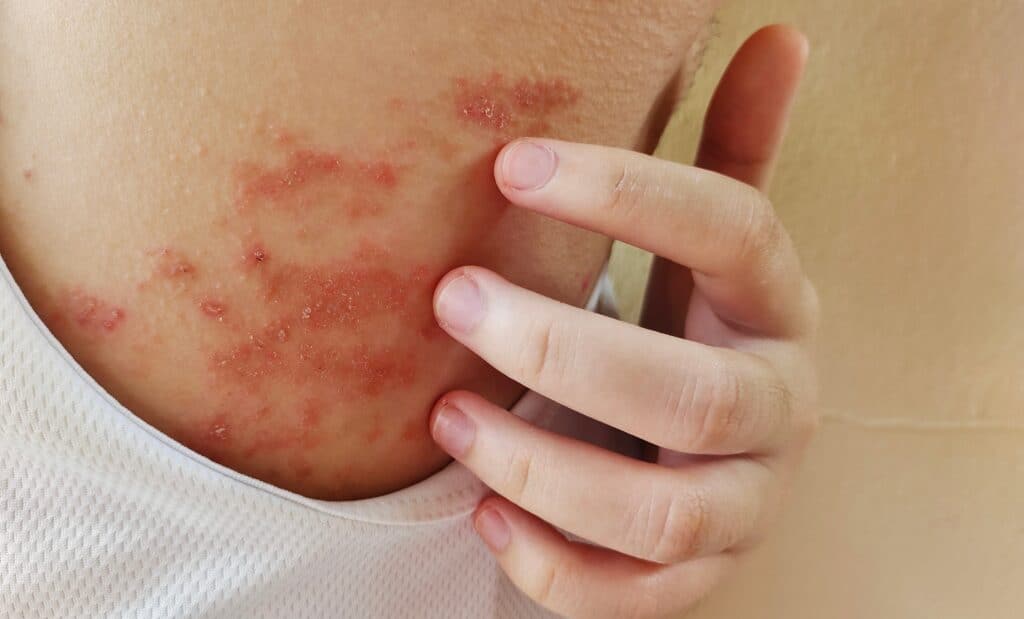 What Is Eczema Understanding This Common Skin Condition What Is Eczema Understanding This Common Skin Condition