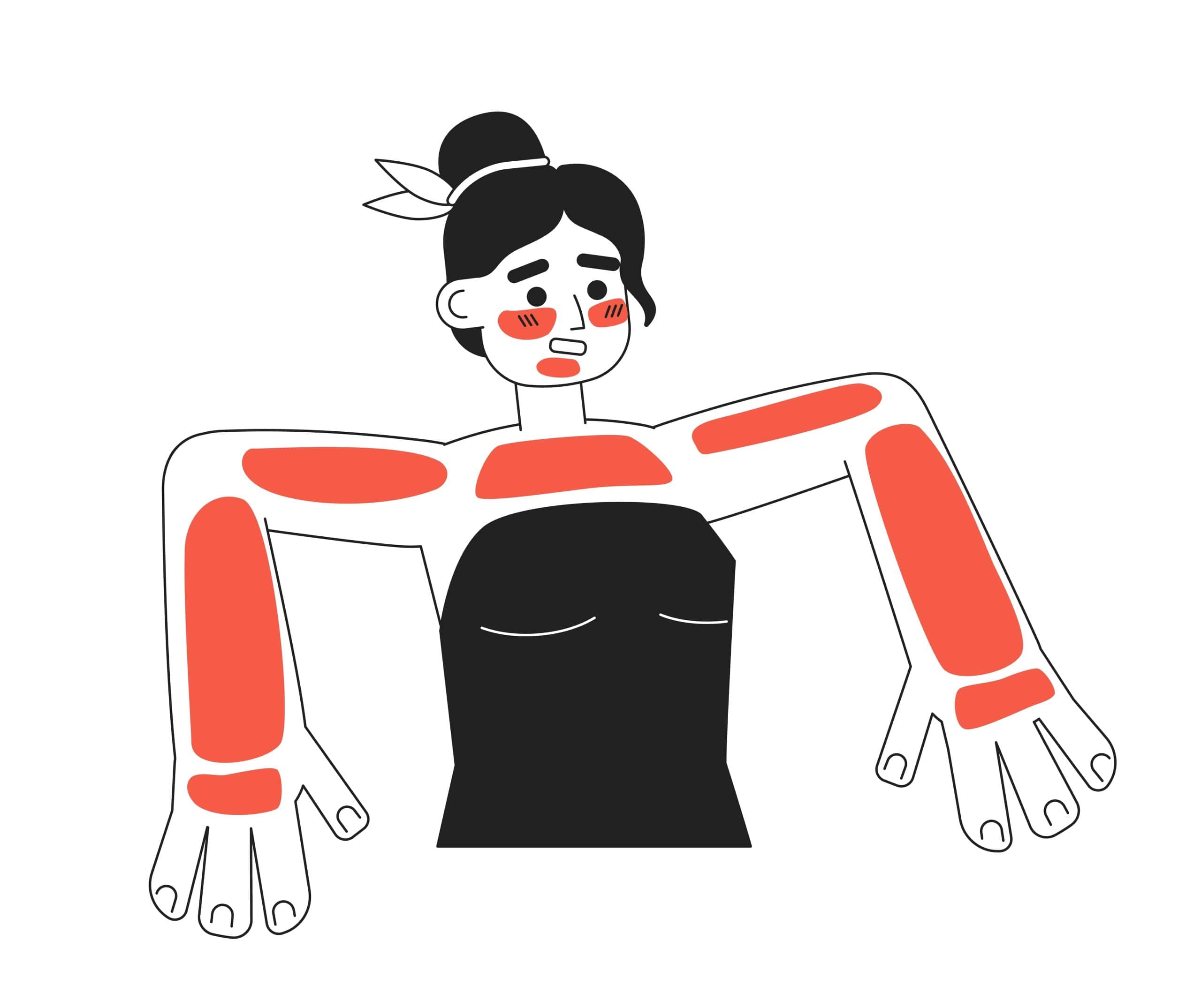 Illustration comparing symptoms of Sunburn vs Sun Poisoning, highlighting differences in skin appearance and severity.